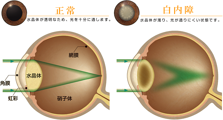 白内障とは？