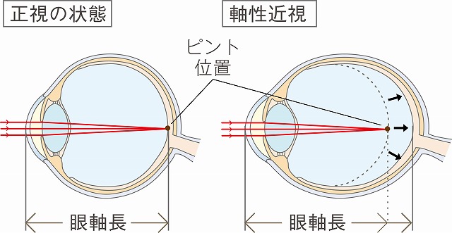近視の進行予防がなぜ重要なのか